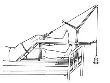 第二种以胫骨结节最高点和腓骨小头连线的中点作为外侧进针点,其内侧