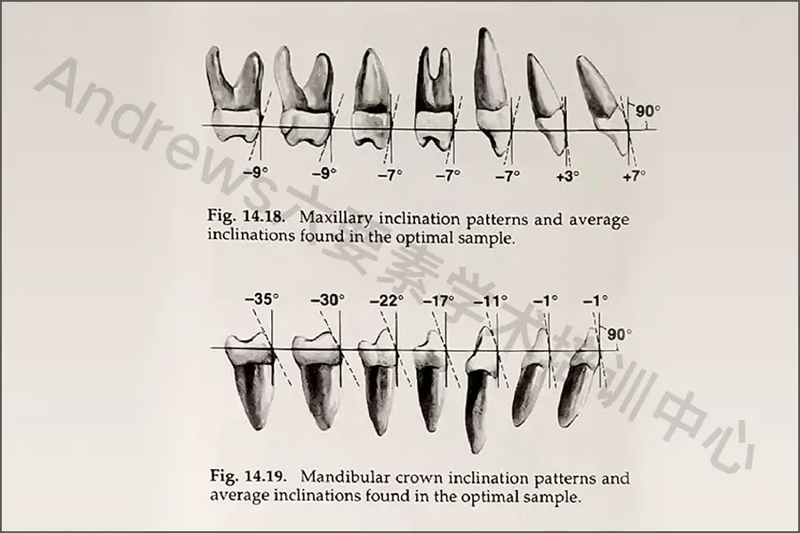 冠倾斜:牙冠长轴的龈方部分在切缘或牙尖的远中方向.