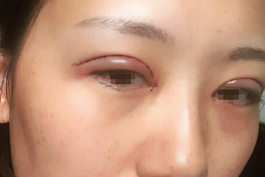 割双眼皮第二天图片