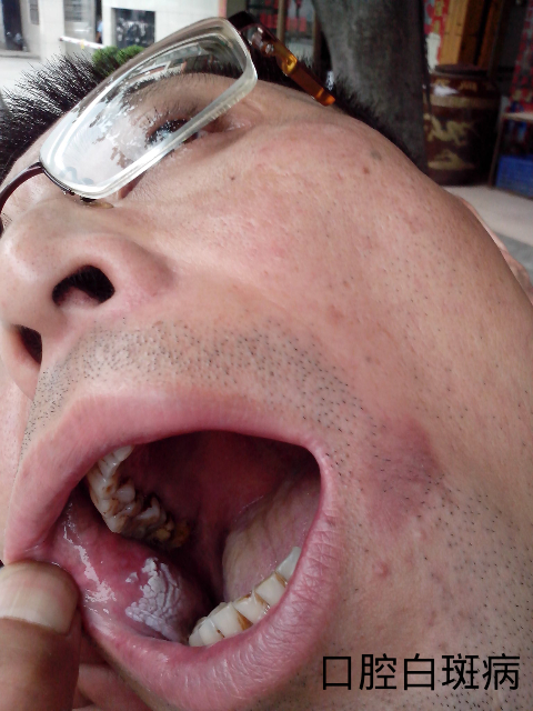 这是口腔白斑吗