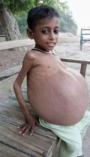 男孩怀孕?肚子比头还要大,真相是里面竟然装的全是粪便!
