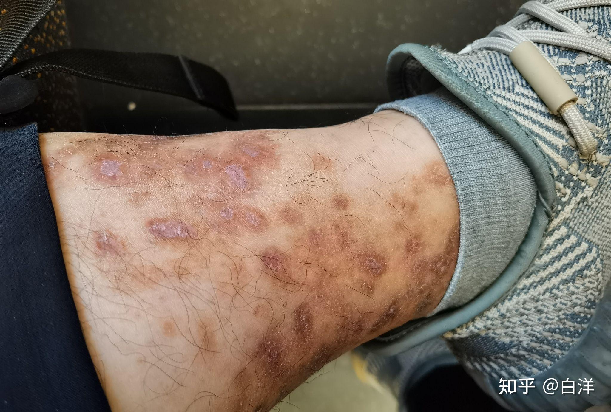 青斑性血管炎,被困扰了5年之久,欢迎来讨论下痊愈经历,大家有痊愈的吗