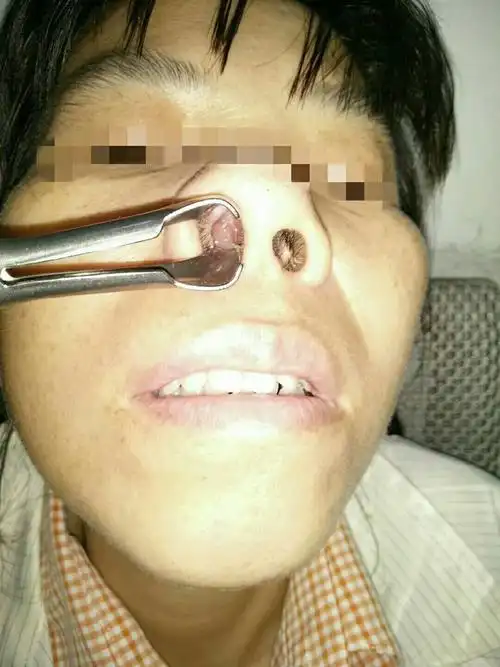 35年的鼻息肉痊愈康复了