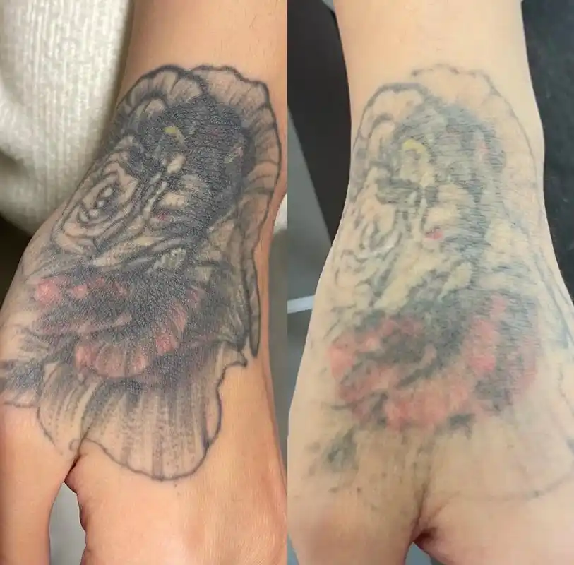 一个手背上的遮盖纹身,有两层图案,洗了一次,恢 - 抖音