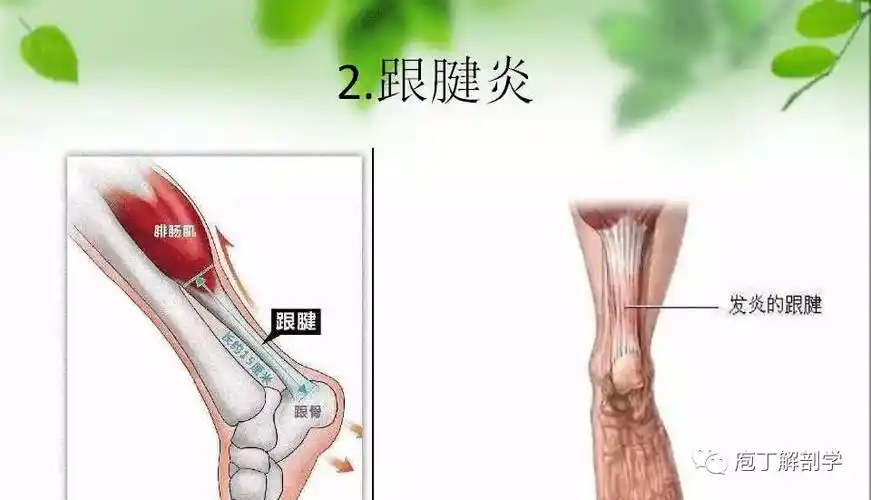 跟腱断裂后穿跟腱靴_跟腱周围炎打封闭_跟腱后滑囊炎