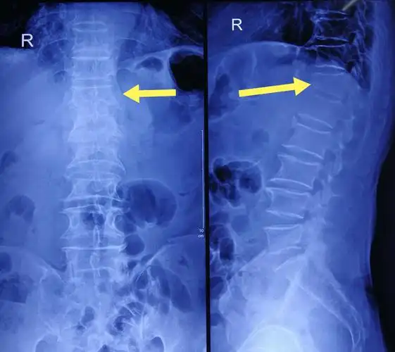 经皮椎体成形术——再次成功治愈5例胸腰椎骨折